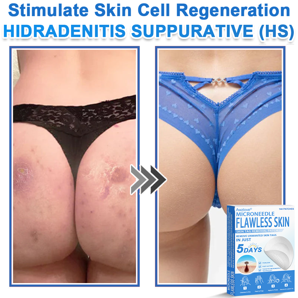 📌 Awzlove® 2-in-1 Microneedle & Hydrocolloid Patch | Raised Moles,Acne,  Flat Warts & Skin Tags Remover | Improves Wrinkles, Scars & Blemishes | Invisible Star Pimple Patches for Face & Body | 🎁🎁4