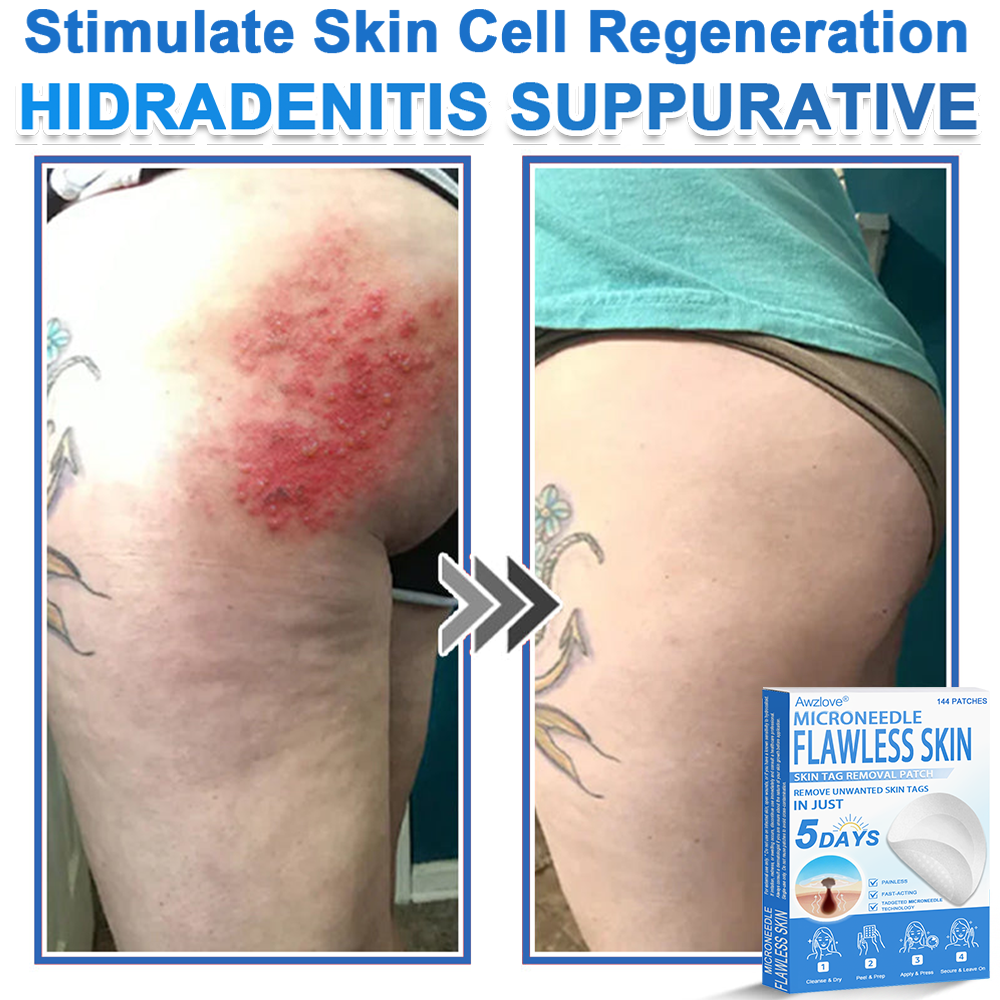📌 Awzlove® 2-in-1 Microneedle & Hydrocolloid Patch | Raised Moles,Acne,  Flat Warts & Skin Tags Remover | Improves Wrinkles, Scars & Blemishes | Invisible Star Pimple Patches for Face & Body | 🎁🎁4